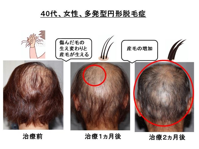 円形脱毛症　病院